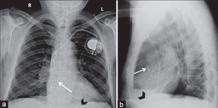 Two x-ray pictures of a human chest, with some wires and a chunky artificial shape visible